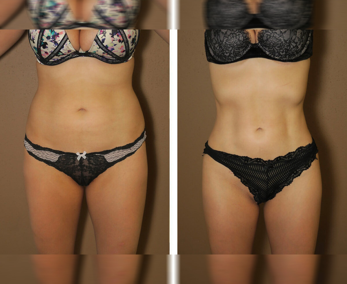 Before After 1