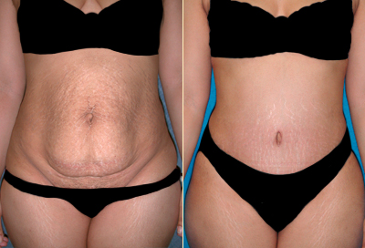 Abdominoplasty Results