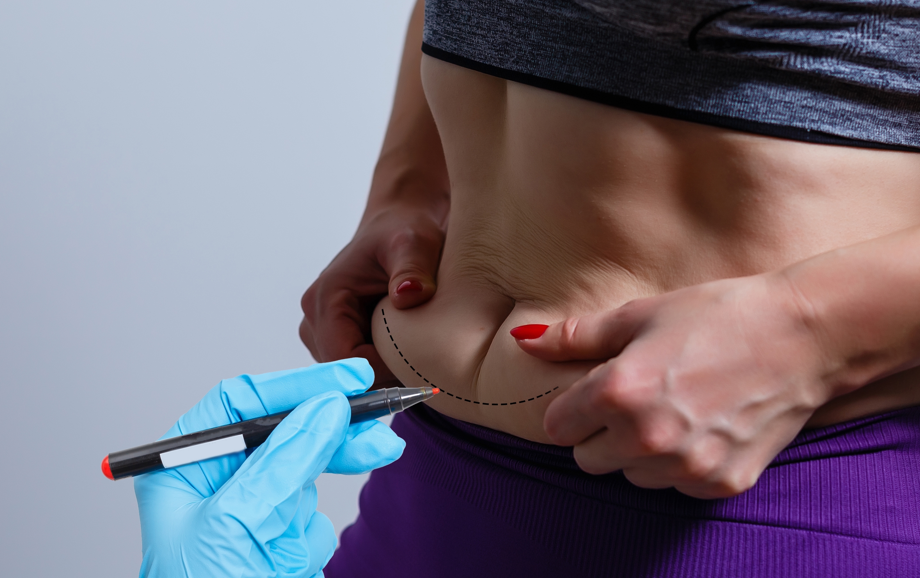 Abdominoplasty Procedure