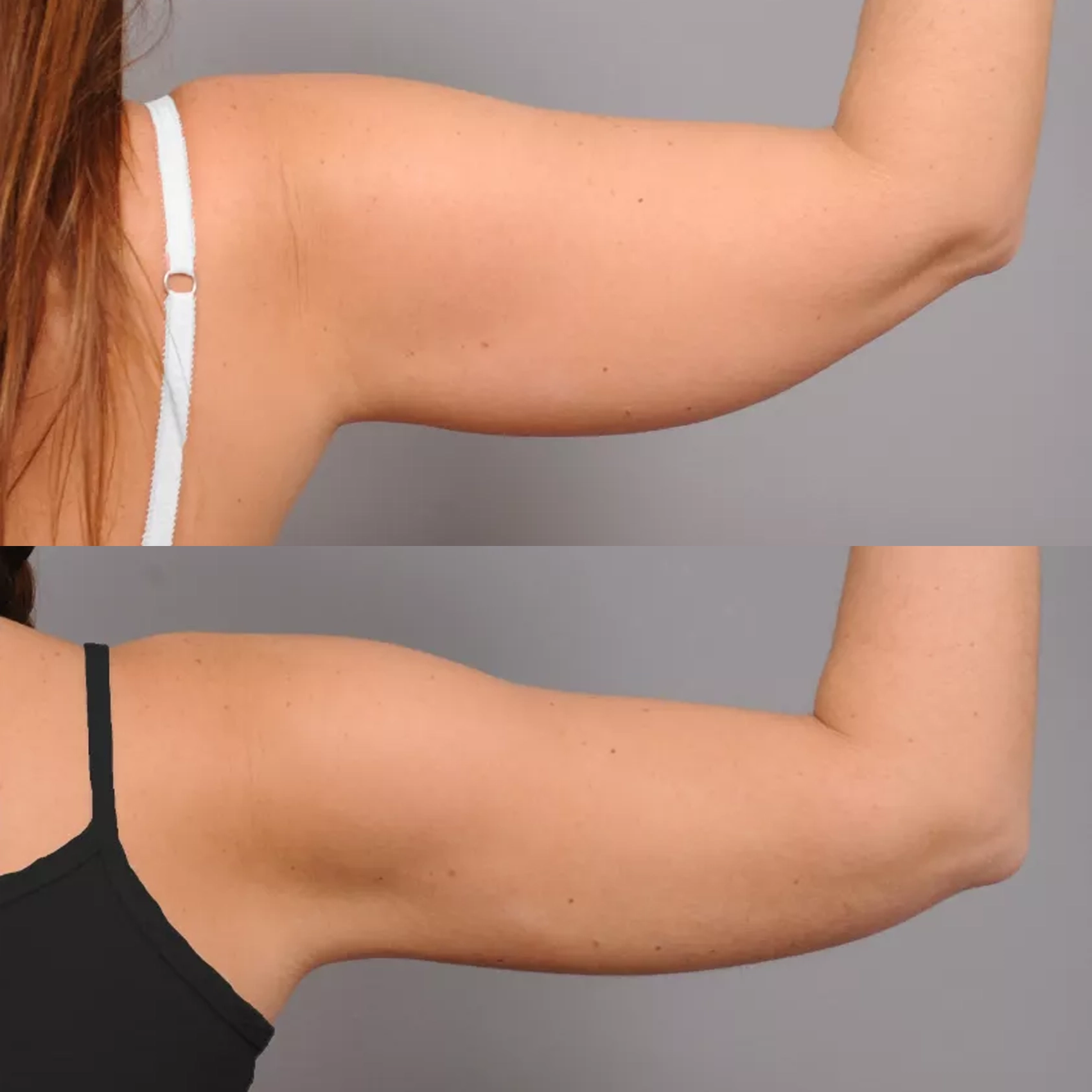 Arms & Legs Lipo
