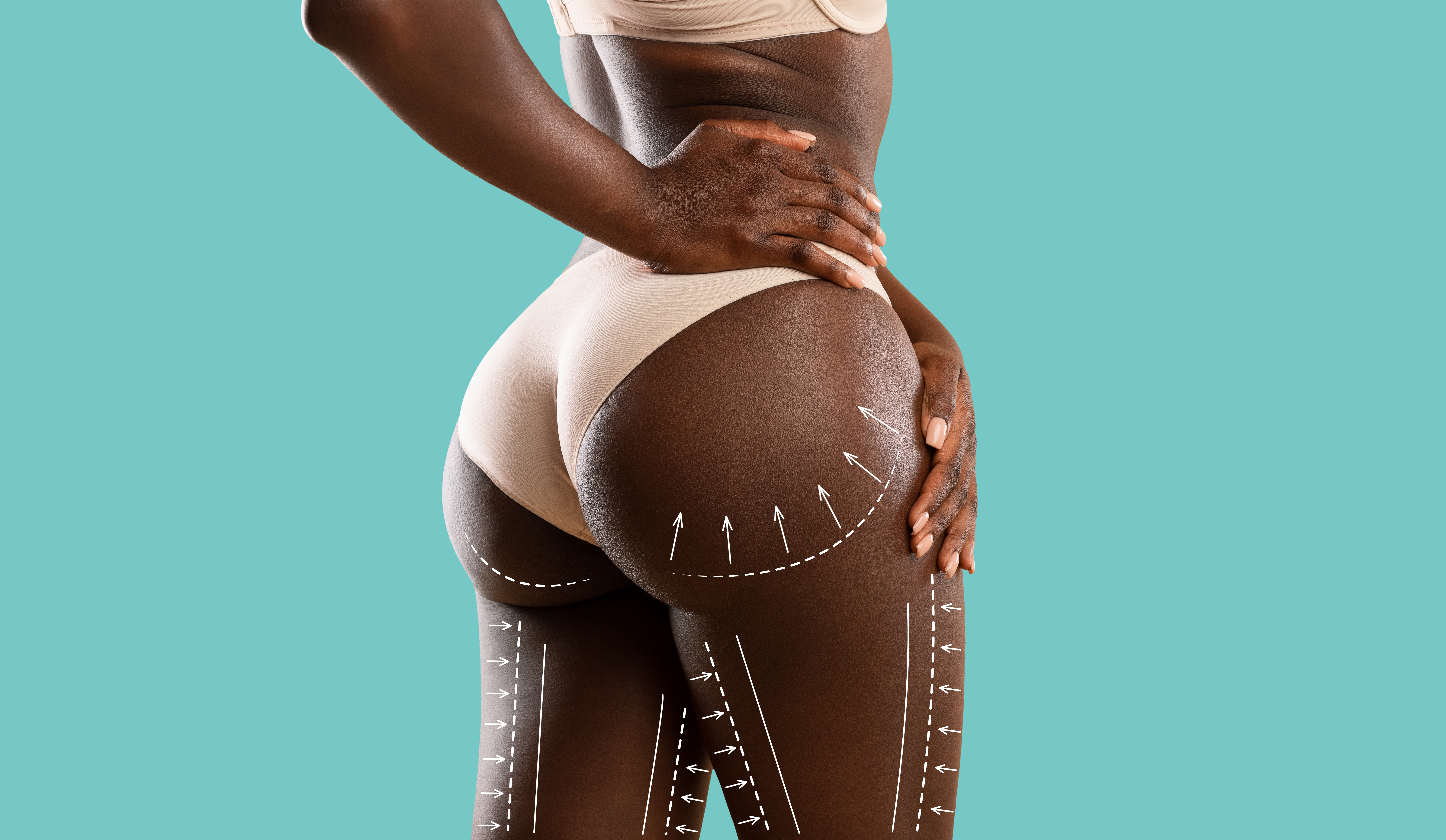 Liposuction Results