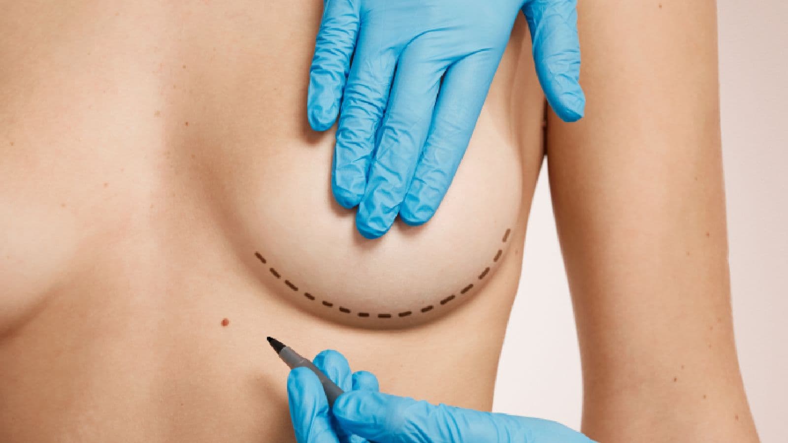 Breast Lift | FK Clinic