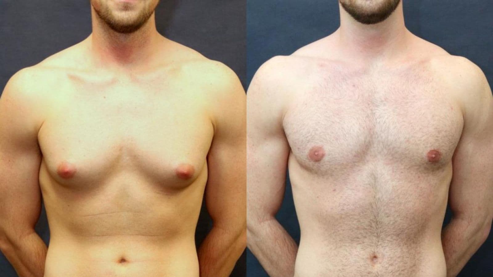 Gynecomastia | FK Clinic