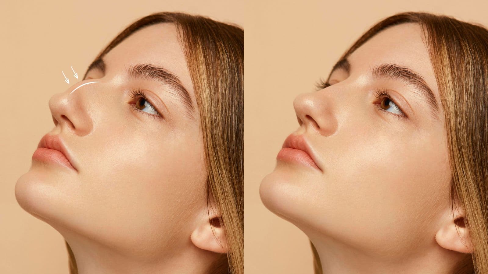 Rhinoplasty | FK Clinic