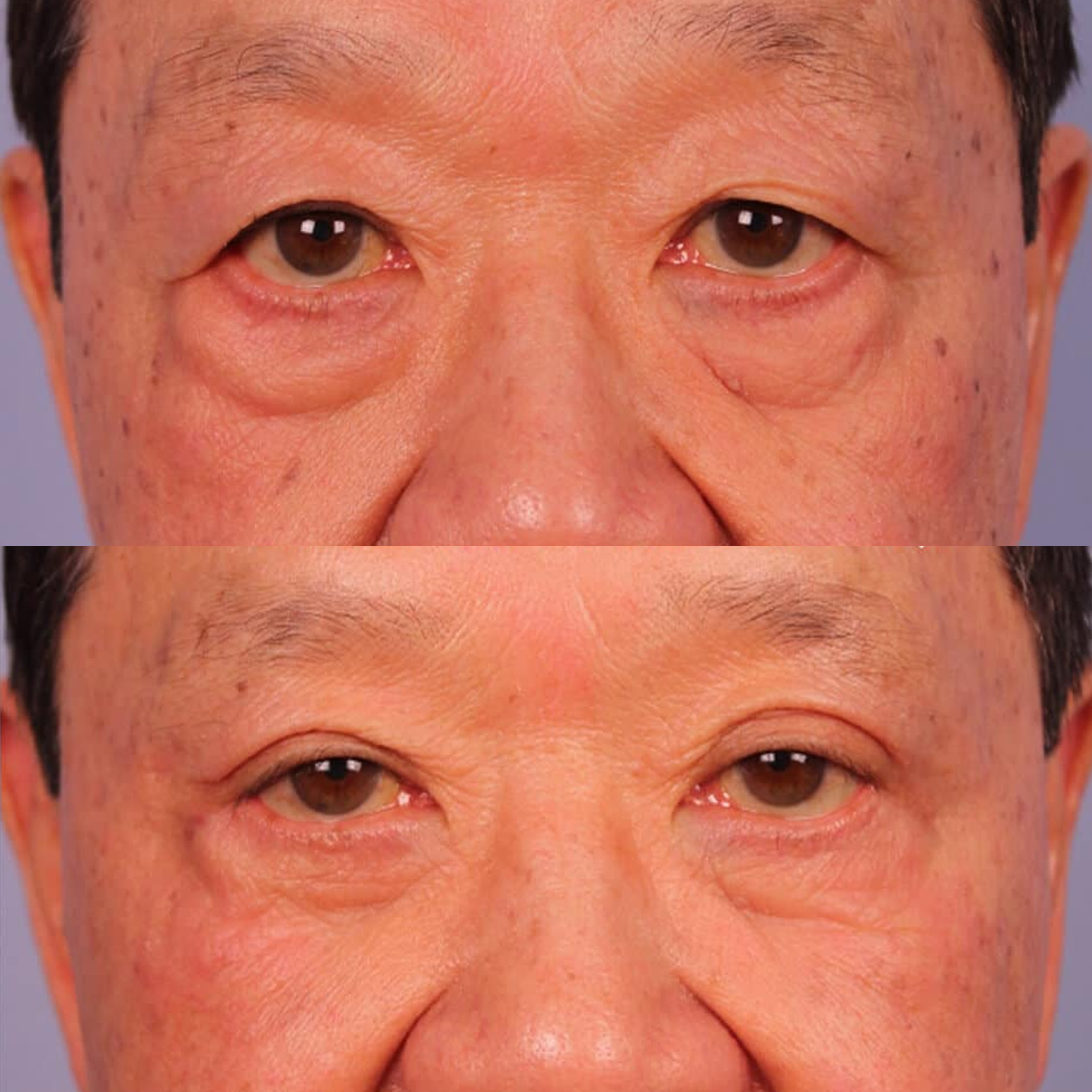 Before After 2