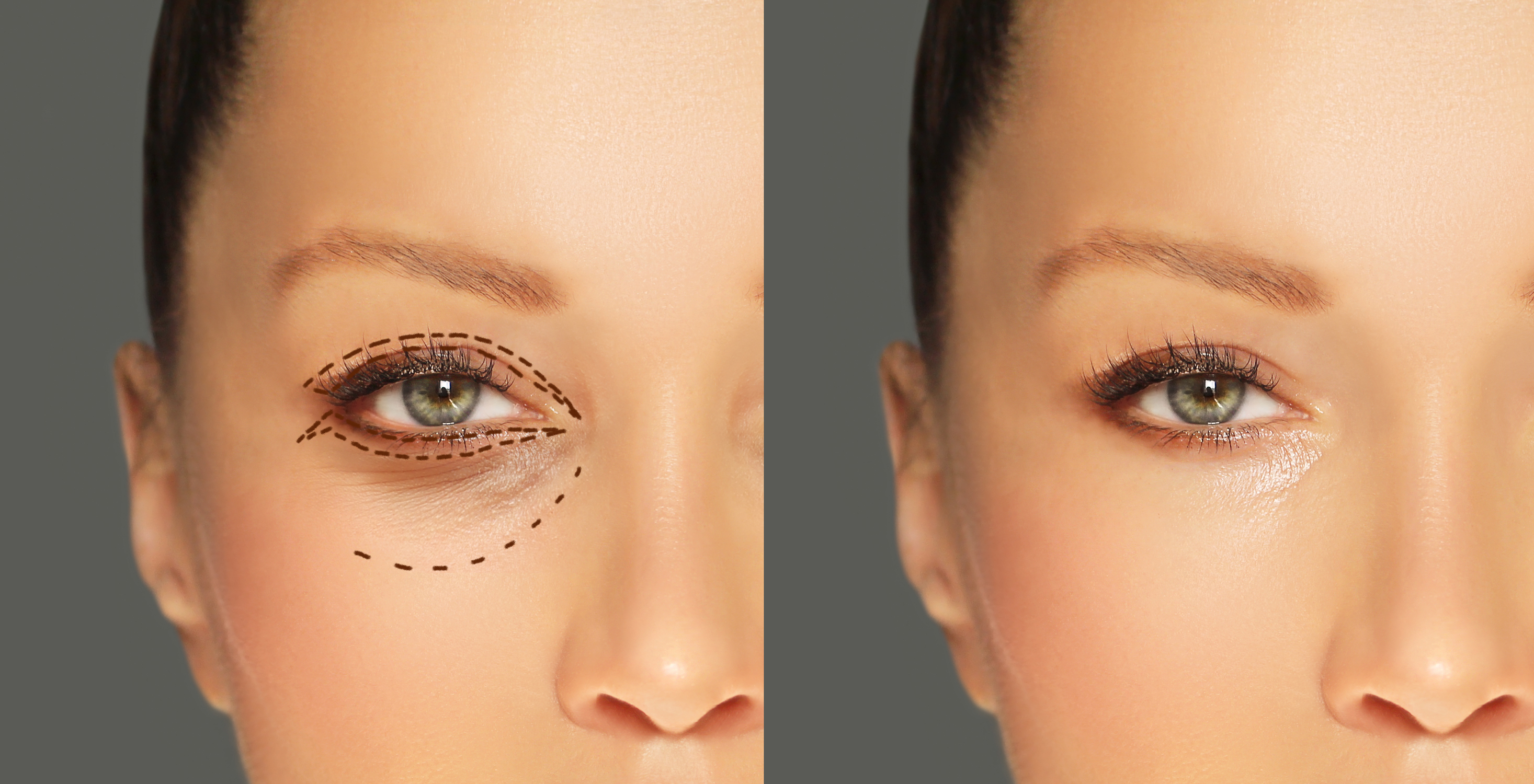 Blepharoplasty Procedure
