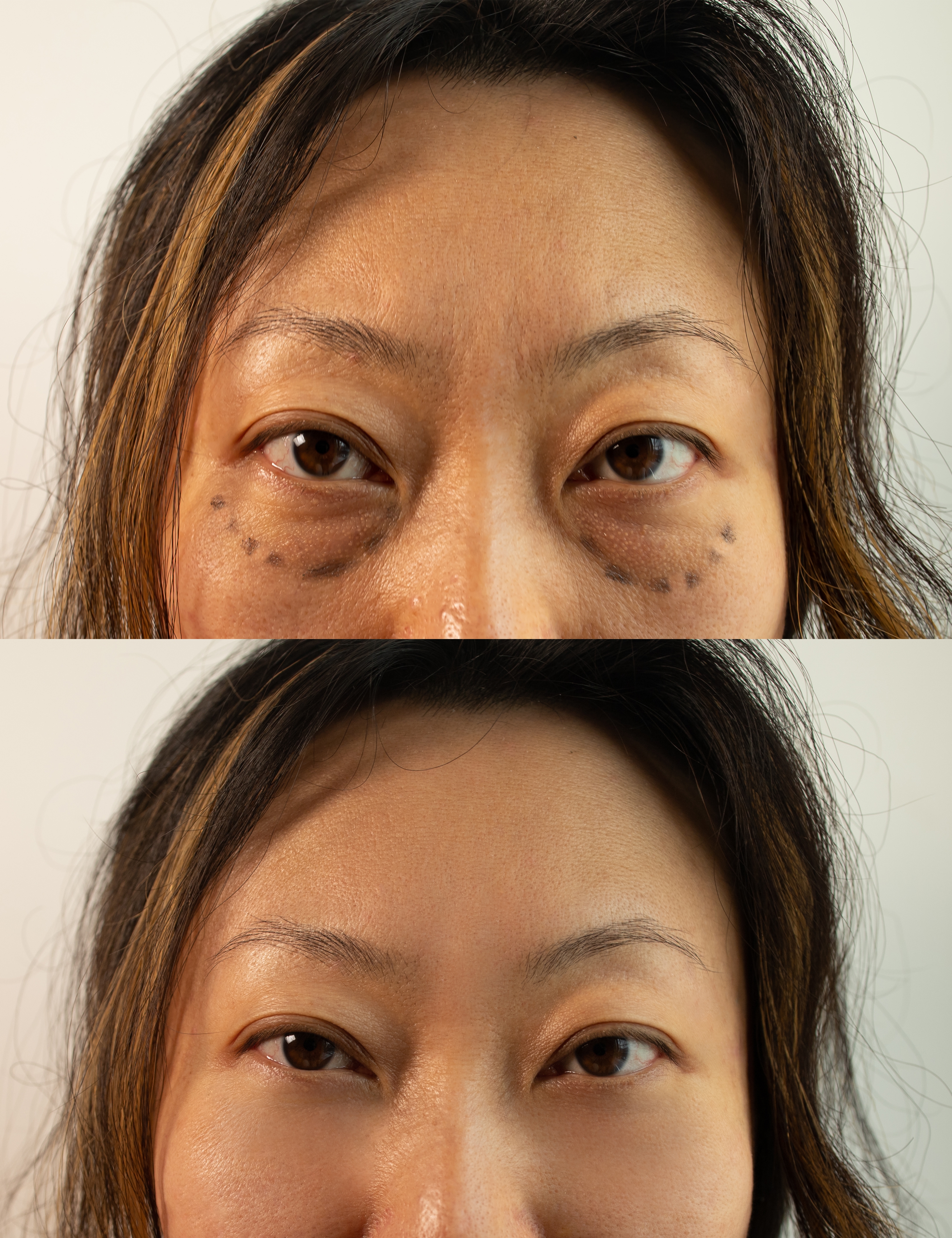 Blepharoplasty Results